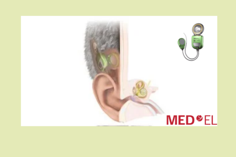 MED-EL lance TICI UNICO, un implant cochléaire totalement invisible